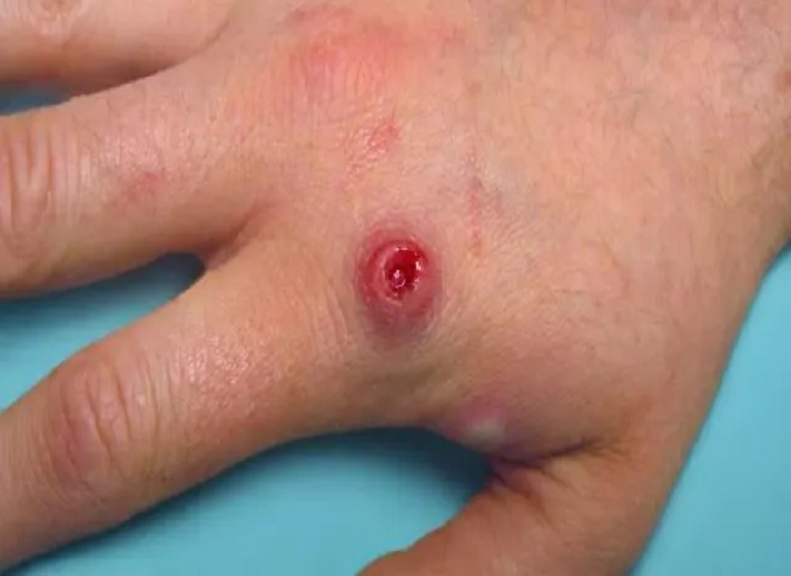 Pochopenie Monkeypox a ako zabrániť？