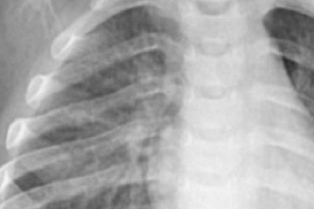 Rýchla detekcia Chlamydia pneumoniae: spoľahlivé a efektívne